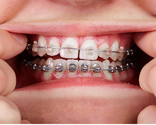 Modern Braces