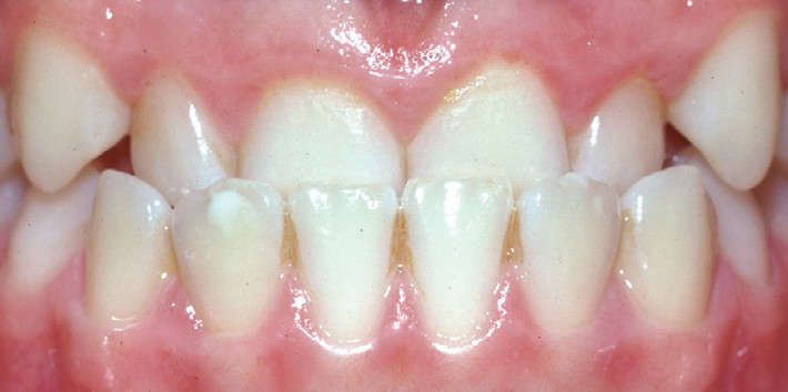 Anterior Crossbite