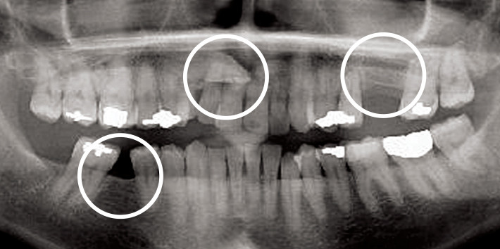 Impacted/Tipped/Missing Teeth