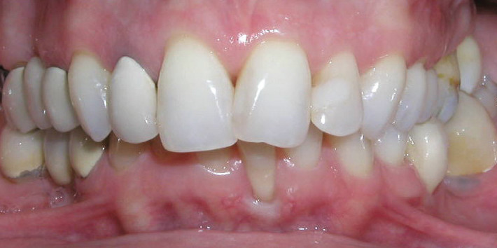 Periodontal Problems