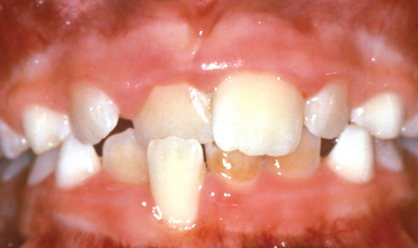 Crossbite of Front Teeth