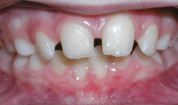 Diastema