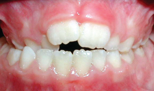 Crossbite of Back Teeth