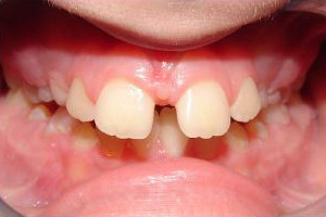 Anterior Gap and Overbite (Before)