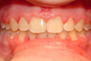 Anterior Gap and Overbite (After)
