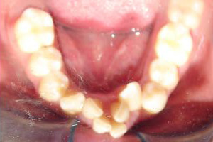 Severe Crowding Treated without Extracting (Before)