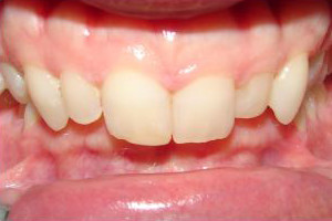 Overbite and Overjet (Before)