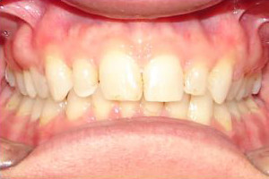 Overbite and Overjet (After)