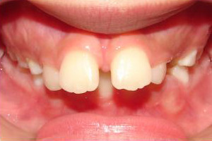 Overbite and Diastema (Before)