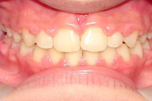 Overbite and Diastema (After)