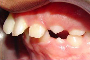 Upper Flaring of Teeth (Before)