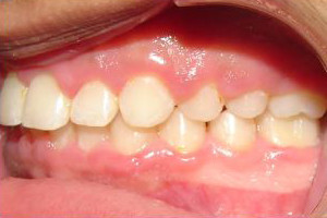 Upper Flaring of Teeth (After)