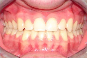 Underbite and Cross Bite (After)