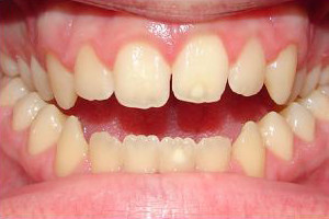 Cross Bite and Open Bite (Before)