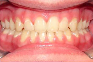 Cross Bite and Open Bite (After)